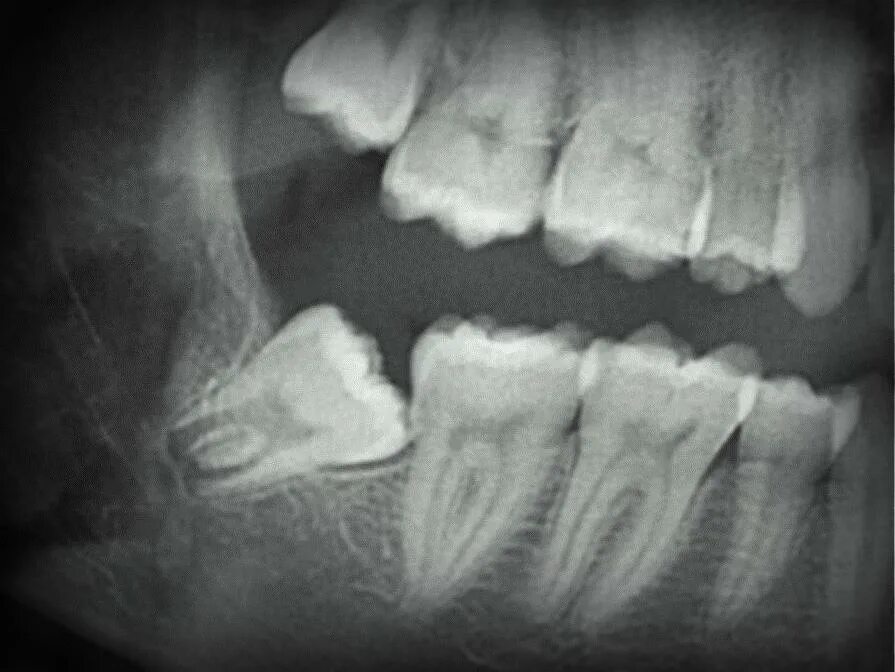 Зуб 8 нижний. Ретинированный дистопированный зуб мудрости. Ретинированный зуб мудрости рентген. Дистопированный премоляр. Ретинированного зуба и дистопированного зуба.