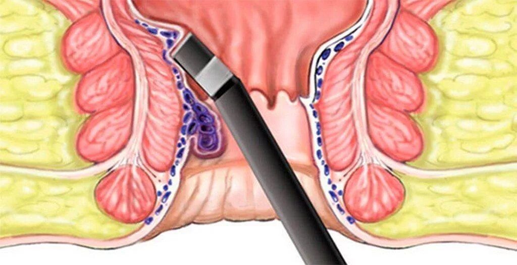Инфракрасная коагуляция геморроя. Методику инфракрасной фотокоагуляции геморроидальных узлов.. Инфракрасная электрокоагуляция геморроидальных узлов. Тромбоз узла свечи