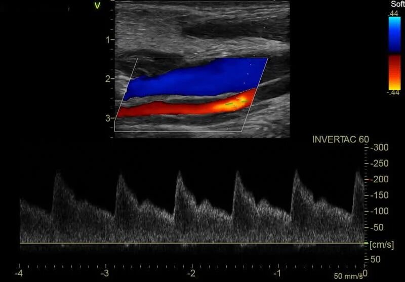 УЗДГ – ультразвуковая допплерография сосудов. Ультразвуковая допплерография бца. УЗИ УЗДГ брахиоцефальных сосудов. Дуплексное сканирование брахиоцефальных артерий бца ( УЗДГ ).