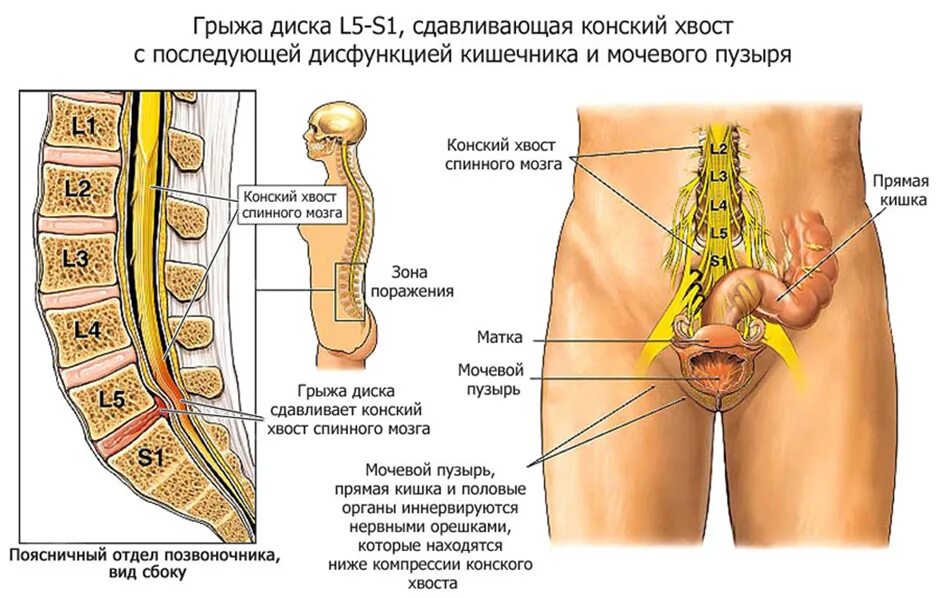 Дисков l4-s1 отдела позвоночника. Диски l5-s1 в позвоночнике. Грыжа l5-s1. Позвоночный диск l5-s1.