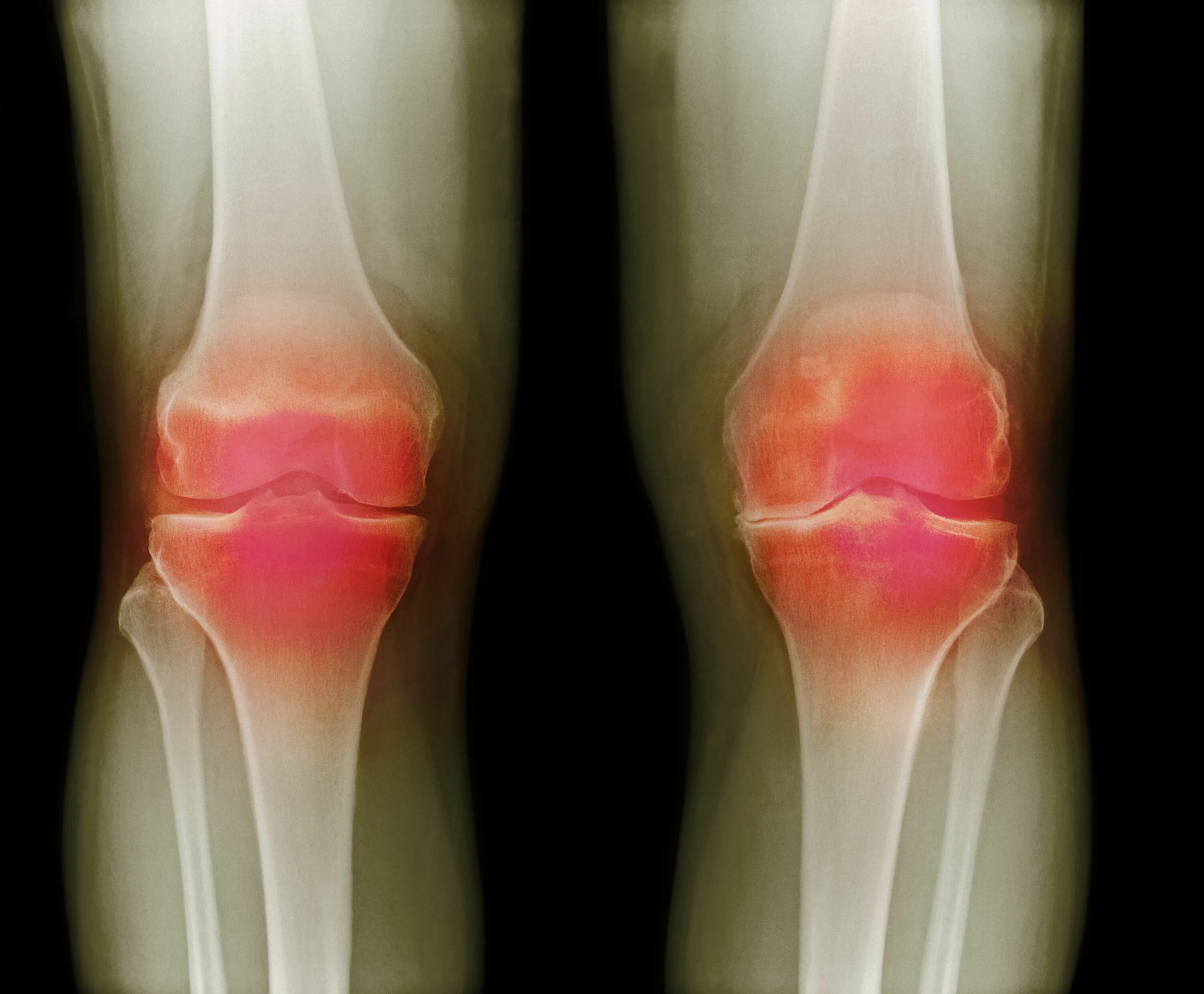 Эффективное лечение артроза сустава. Ревматоидный артрит коленного сустава рентген. Подагрический артрит коленного сустава рентген. Лигаментоз крестовидных связок коленного сустава что это. Ревматический артрит коленного сустава.