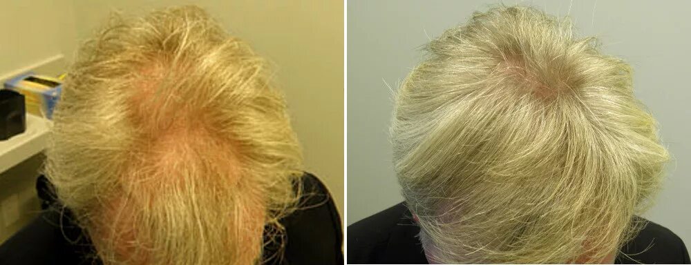 Выпадение волос после обесцвечивания. Облысение после осветления волос. Женское облысение до после. Выпадают волосы 50 лет