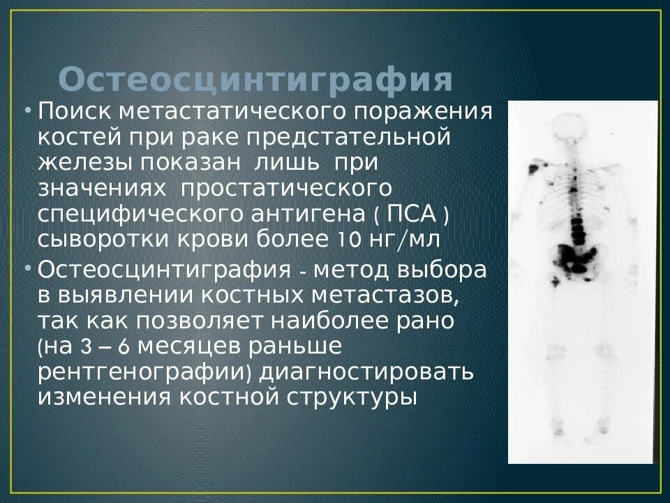 Очаговые изменения костей. Метастатическое поражение костей. Метастатические опухоли костей. Выявление метастазов в костях. Очаги патологической гиперфиксации РФП В костях что это такое.