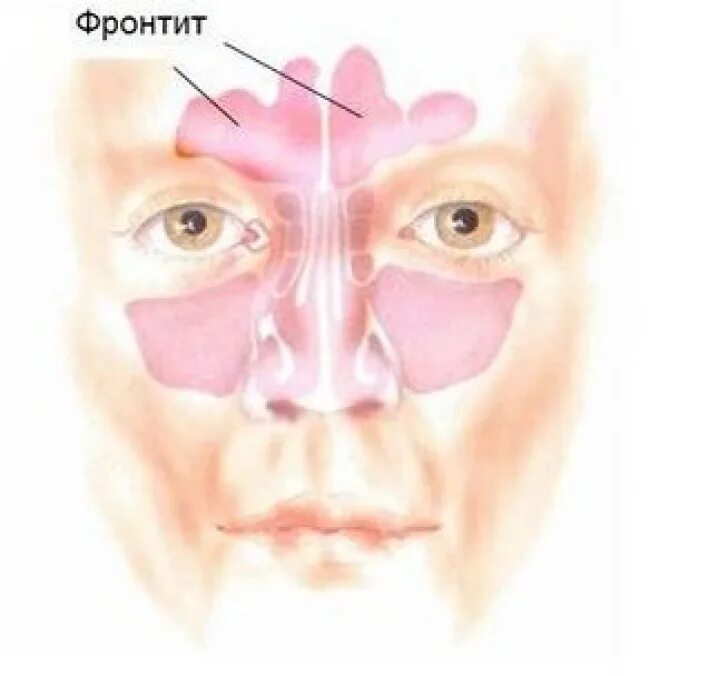 Этмоидит сфеноидит фронтит. Синусит гайморит фронтит. Хронический этмоидит антибиотики. Гайморовых пазух слизистой оболочки