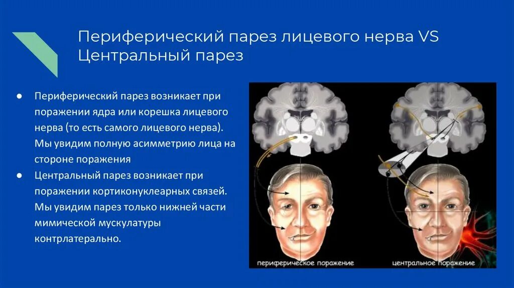 Порез лицевого. Центральный и периферический парез лицевого нерва. Центральный парез лицевого нерва. Периферический паралич лицевого нерва. Парез и паралич лицевого нерва.