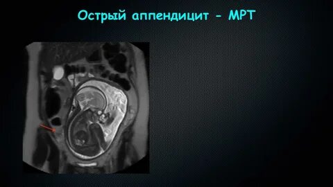 Травматические повреждения органов брюшной полости
