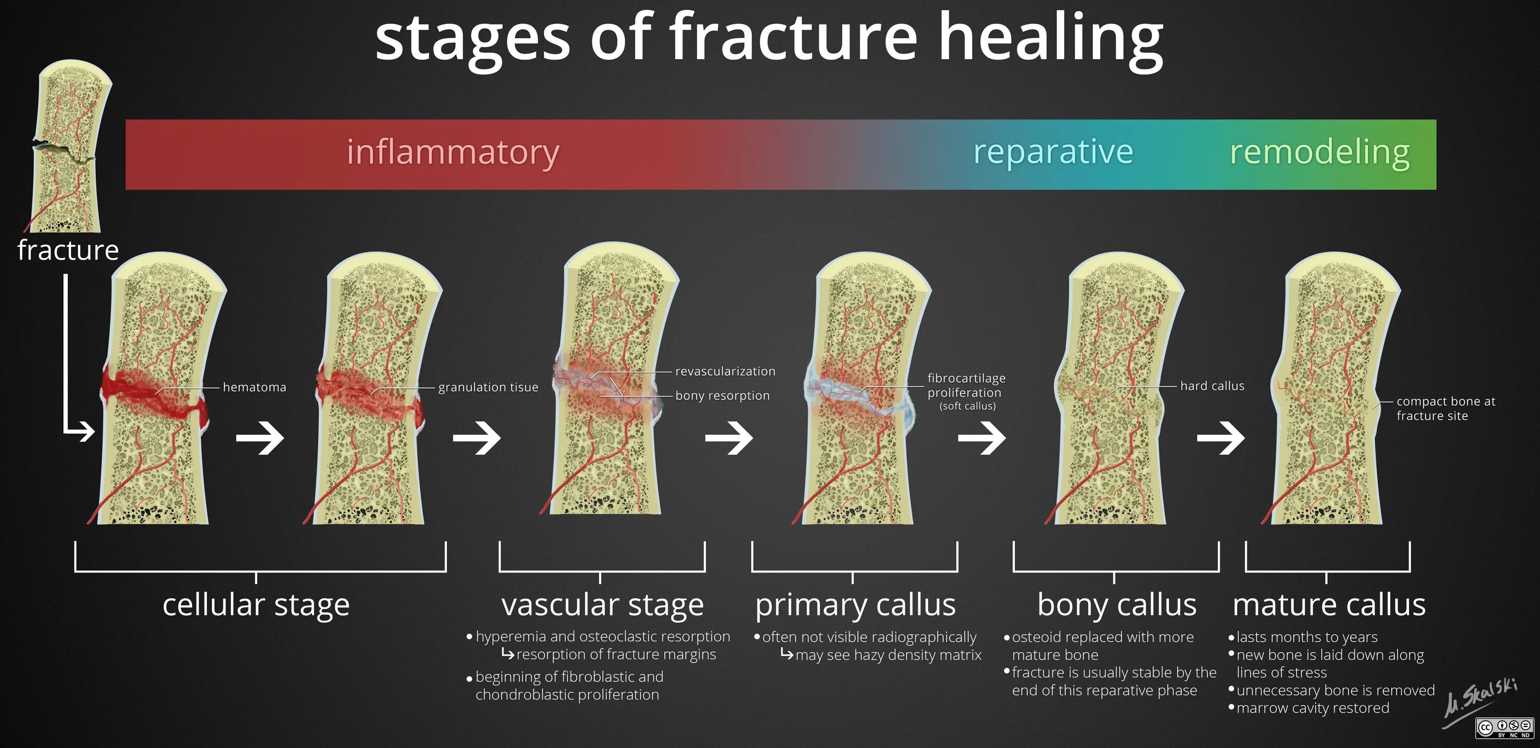 The fracture can be