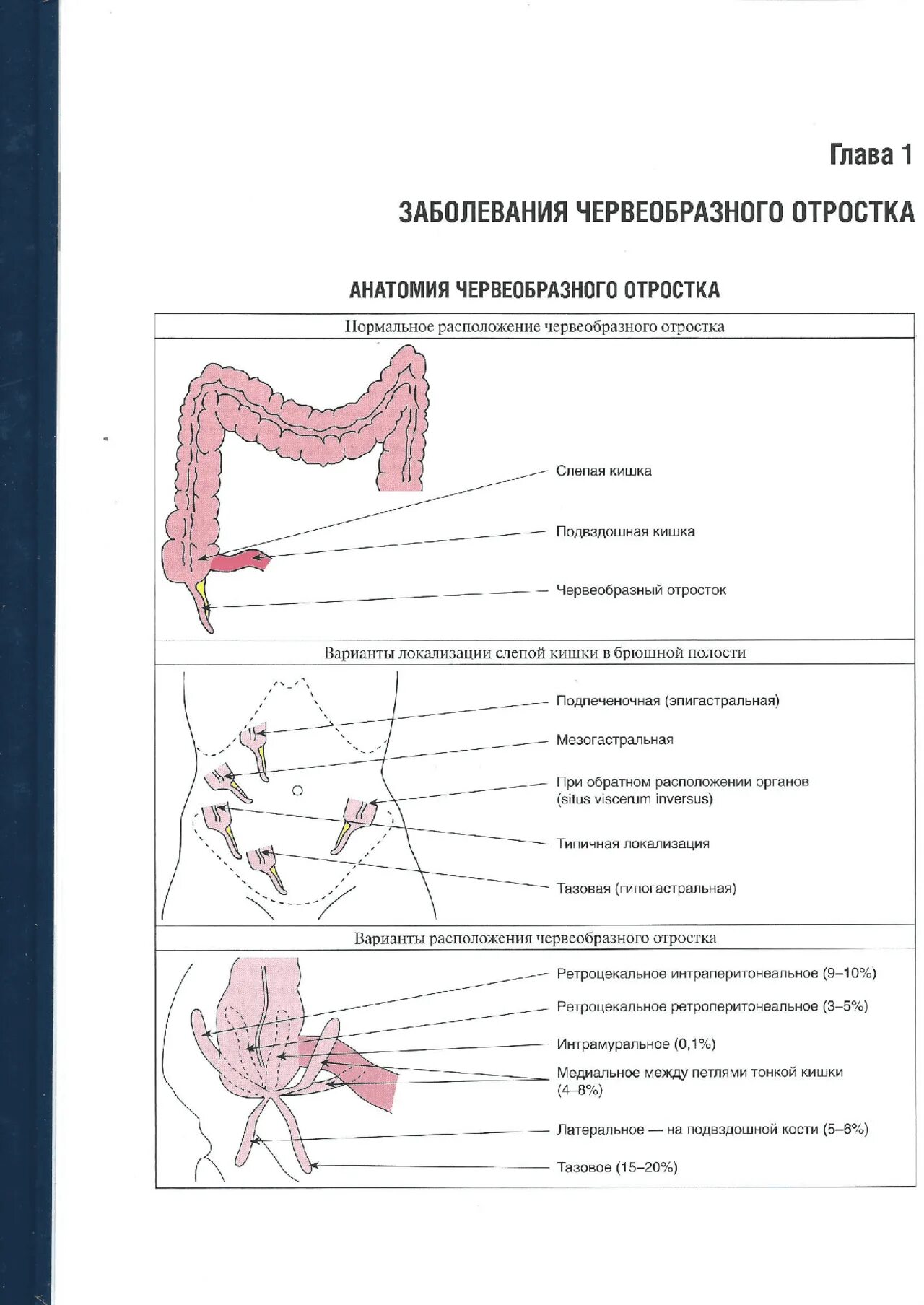 Локализация боли при остром аппендиците. Топография червеобразного отростка. Аппендицит положение отростка. Локализация червеобразного отростка. Червеобразный отросток топография анатомия.