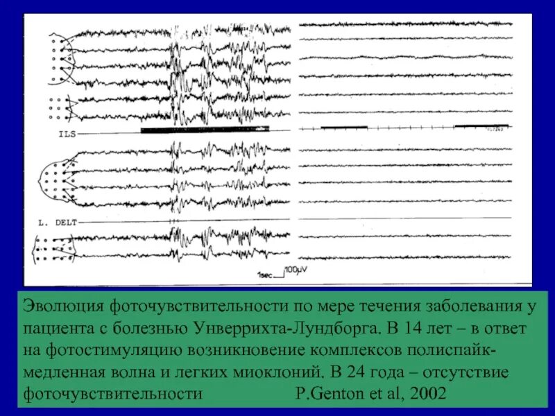 Медленные волны на ээг. Приступы миоклонии. Болезнь Унферрихта-Лундборга. Миоклонус эпилепсия. Эпилепсия Унферрихта- Лундборга.