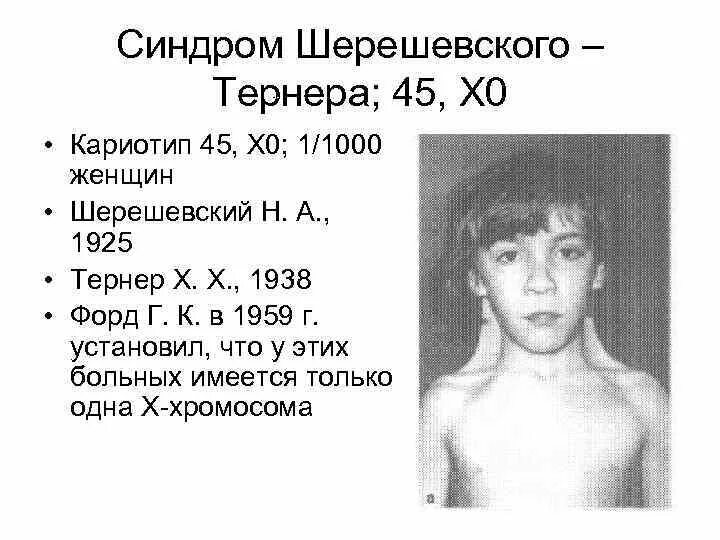 Синдром шерешевского тернера кратко. Синдром шерешевского тернера 45,0х. наследственная патология шерешевского-тернера. шерешевского-тернера (х0).. синдром шерешевского тернера характеристика.