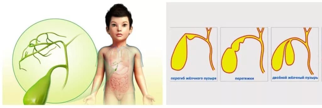 Врожденная патология желчного пузыря. Загиб,перетяжка желчного пузыря.джвп.. Джвп Перегиб желчного пузыря. Желчный изгиб у ребенка
