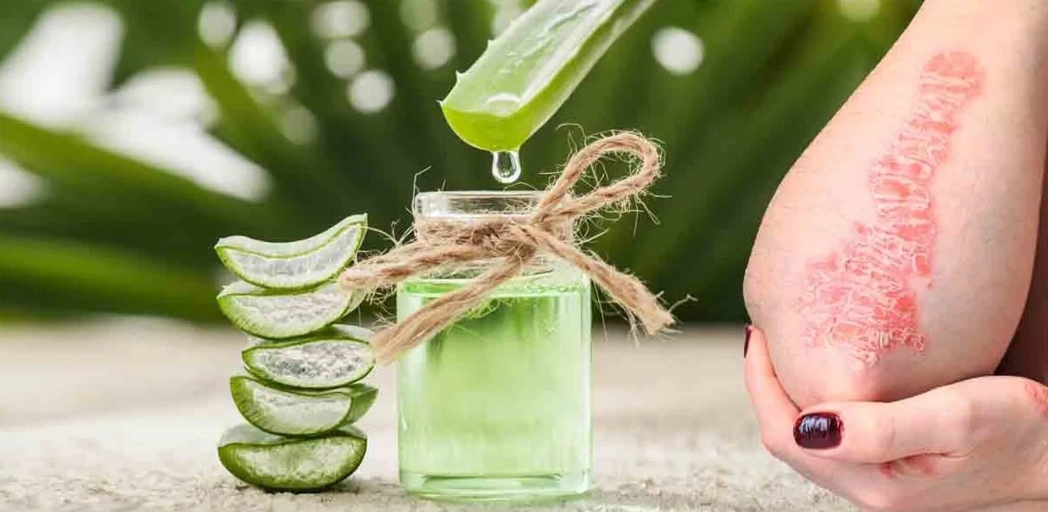 Aloe Vera. Лечение столетником