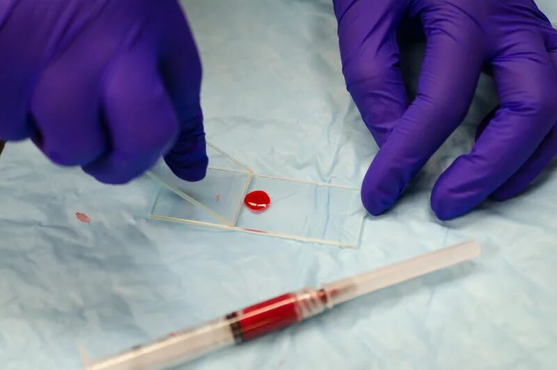 Для диагностики малярии забор крови осуществляют. Мазки крови. Исследование мазка крови. Мазок крови на предметном стекле.