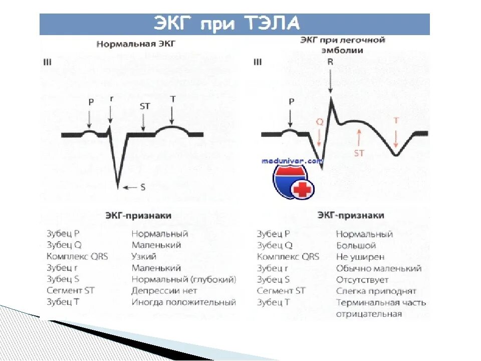 Тромбоэмболия легочной артерии экг. ЭКГ заболевания сердца с расшифровкой. Патология зубца r на ЭКГ. Электроды ЭКГ при декстрокардии. Кардиограмма сердца расшифровка норма таблица.