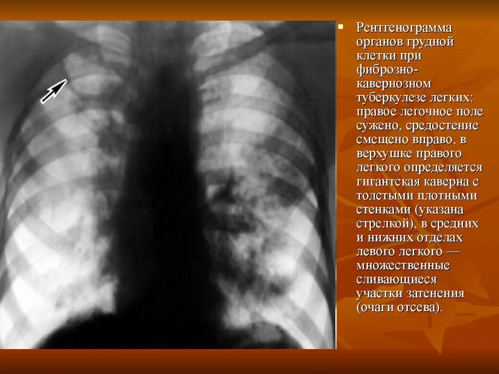 Рентгенография грудной клетки при инфильтративный туберкулез. Рентгенография грудной клетки при инфильтрация туберкулез. Кавернозный туберкулез каверна. Каверна туберкулез рентген.