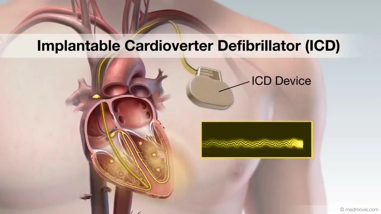 Icd 432