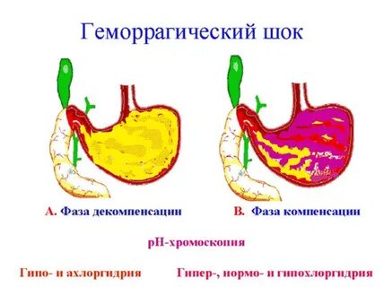Геморрагический шок
