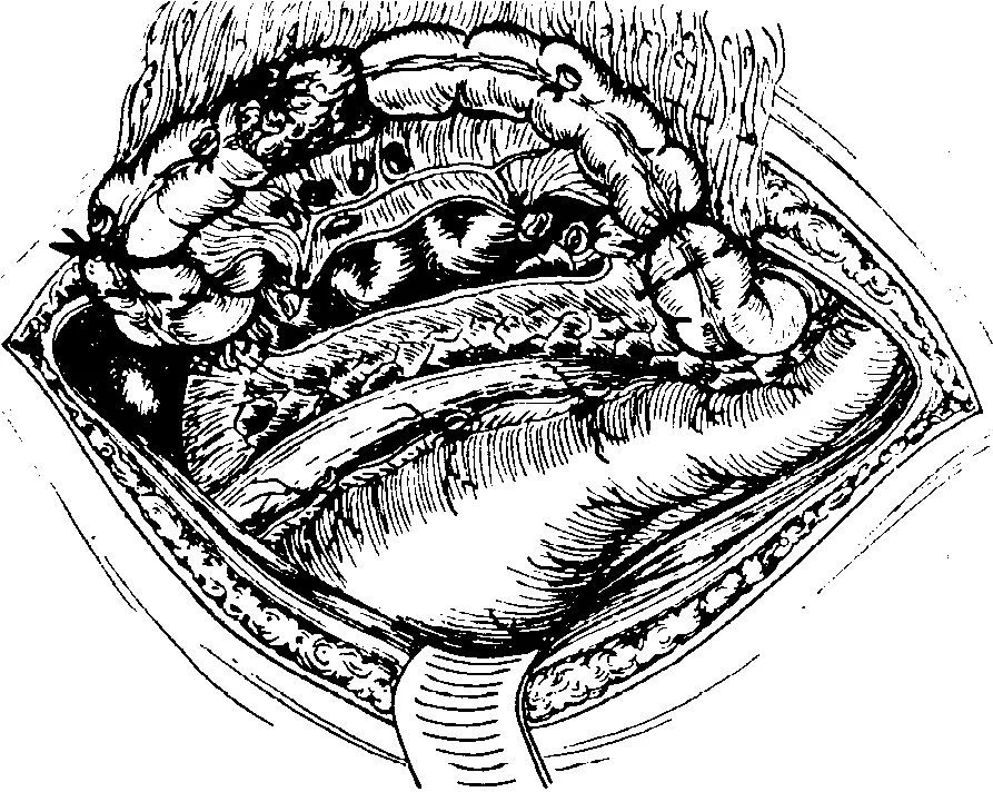 Резекция толстой кишки ободочной. Ушивания ободочной кишки. Стома операция толстой кишки.