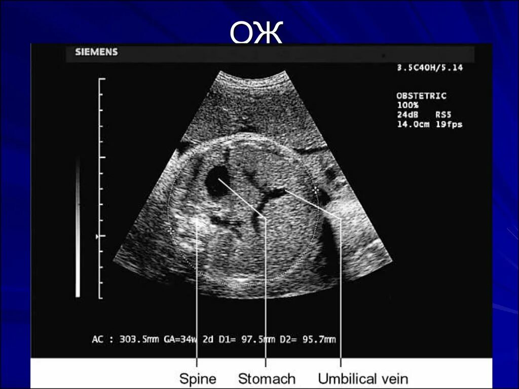 Измерение окружности живота плода УЗИ. Ультразвуковая фетометрия плода. УЗИ таблица беременности. Размеры головки по УЗИ.
