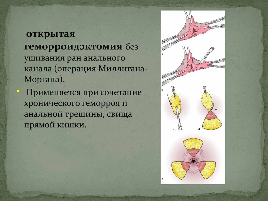 Хроническая трещина форум. Операция Миллигана-Моргана геморроидэктомия. Геморроидэктомия по Миллигану-Моргану. Операция Миллигана-Моргана, Фергюсона. Геморроидэктомия по миллиган Моргану.