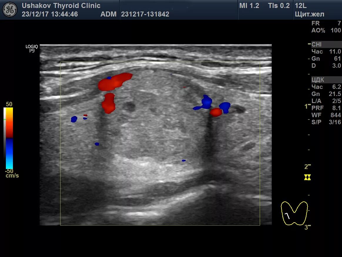 Узел в левой доле щитовидной. Фолликулярная аденома щитовидной на УЗИ. Аденома щитовидной железы на УЗИ. Фолликулярная аденома щитовидной железы УЗИ картина. Эхограммы узлы щитовидной железы.