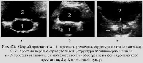 Включения в предстательной железе
