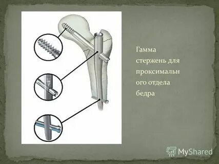 Клинические рекомендации переломы проксимального отдела бедренной