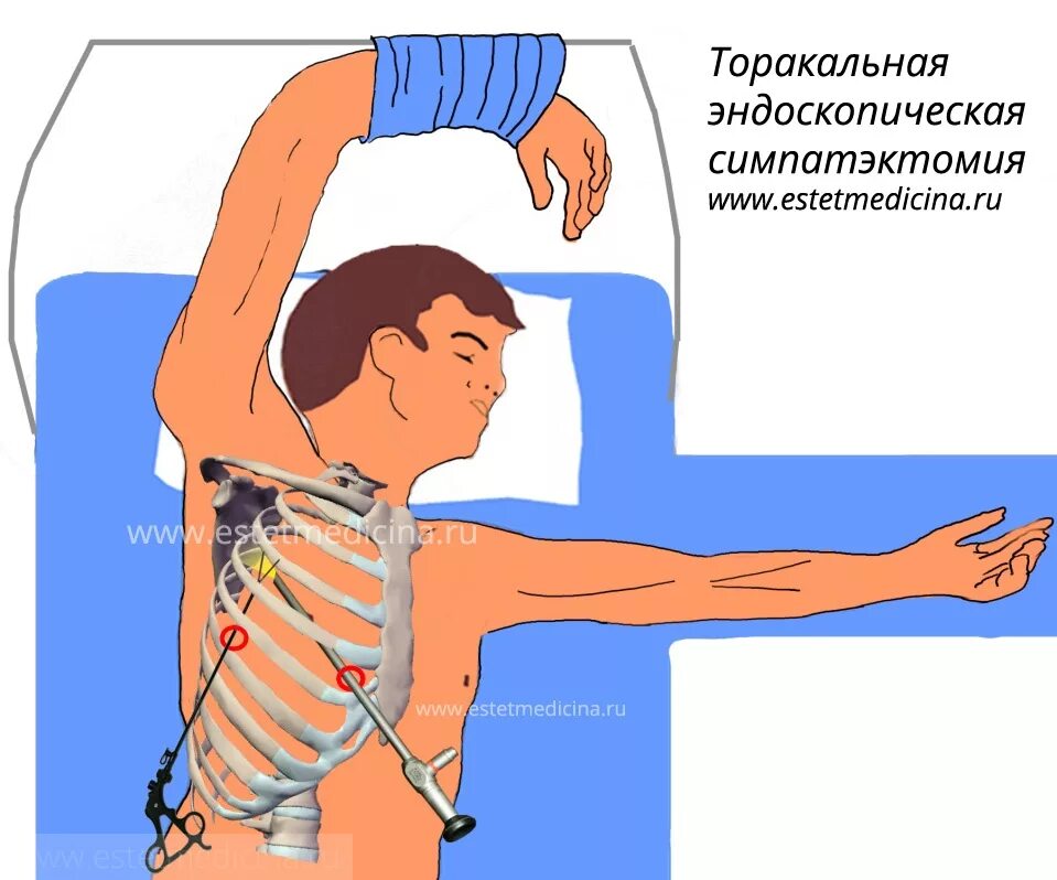 Симпатэктомия цена. Торакальная симпатэктомия. Эндоскопическая торакальная симпатэктомия. Торакоскопическая грудная симпатэктомия. Поясничная симпатэктомия.