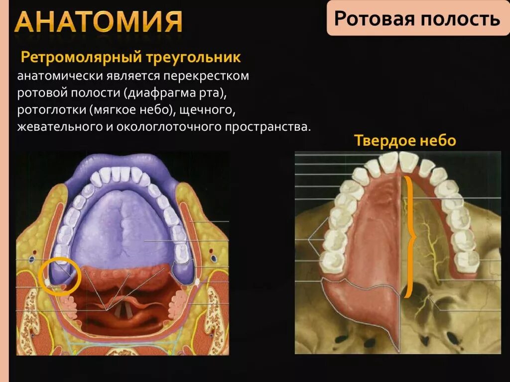 Твердое небо полости рта. Новообразования твердого неба. Онкология ротовой полости.