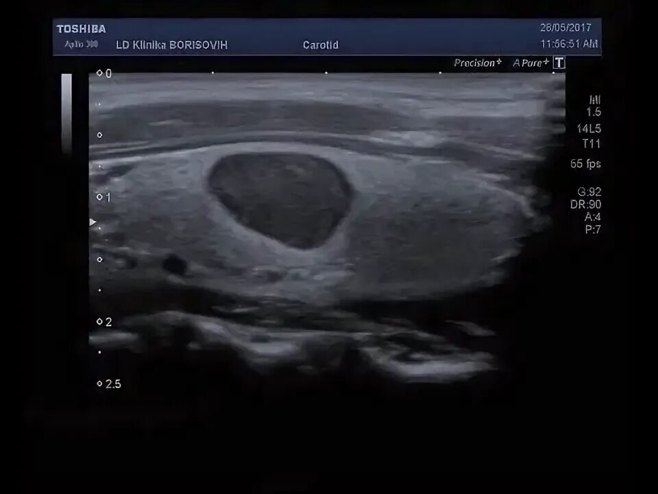 Узлы щитовидной железы tirads. Тирадс 4 щитовидной железы что это такое. Узи щитовидной железы ti-rads2. Ультразвуковая эластография щитовидной железы. Тирадс 3 щитовидной железы.