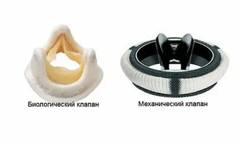 Митральное протезирование