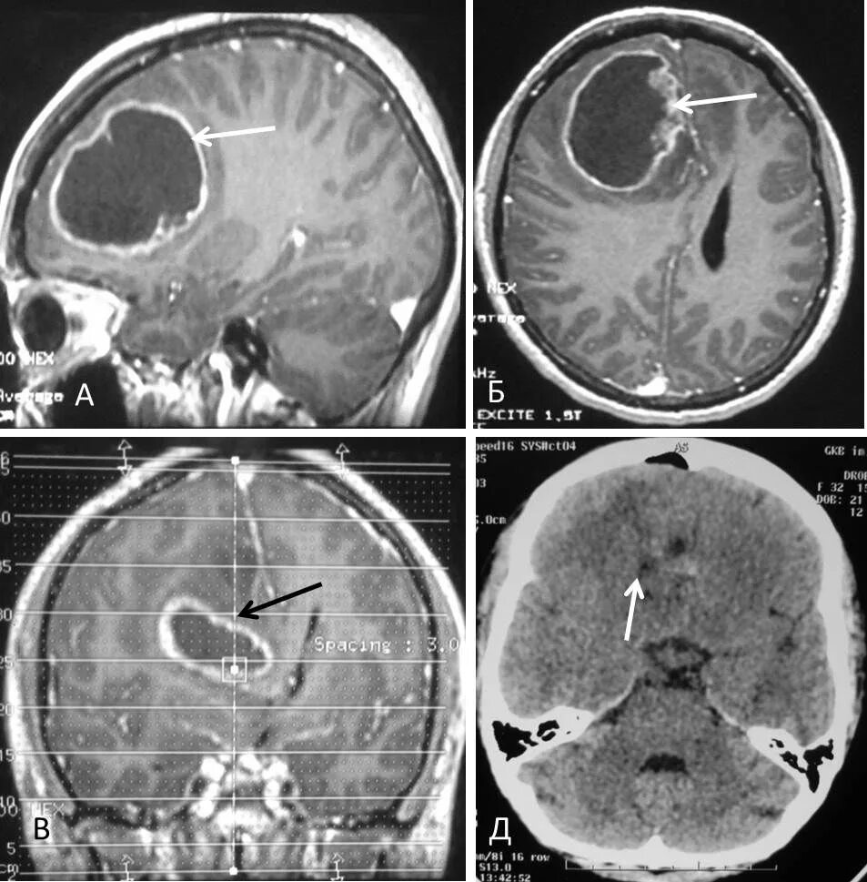 Мультиформная глиобластома. Мультифокальная глиобластома головного. Опухоль мозга глиобластома. Симптомы глиобластомы головного