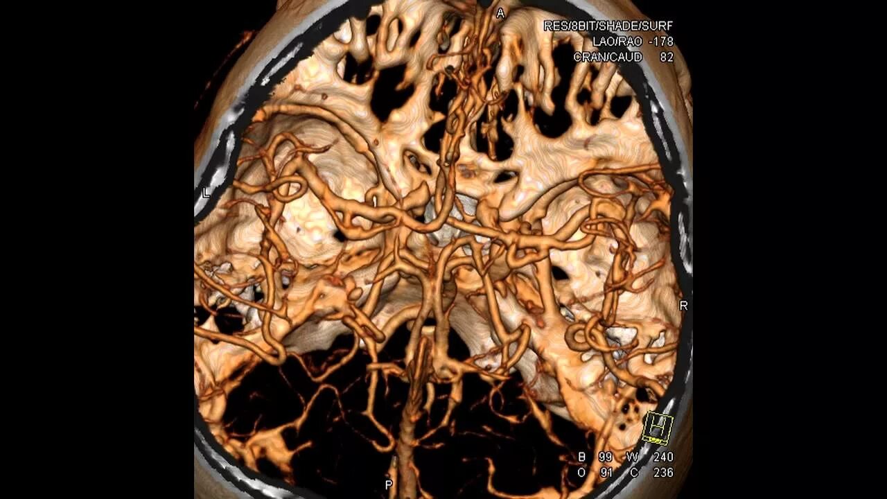 Кт томограмма головного мозга. Мрт ангиография артерий головного мозга. Кт ангиография аневризма головного мозга.