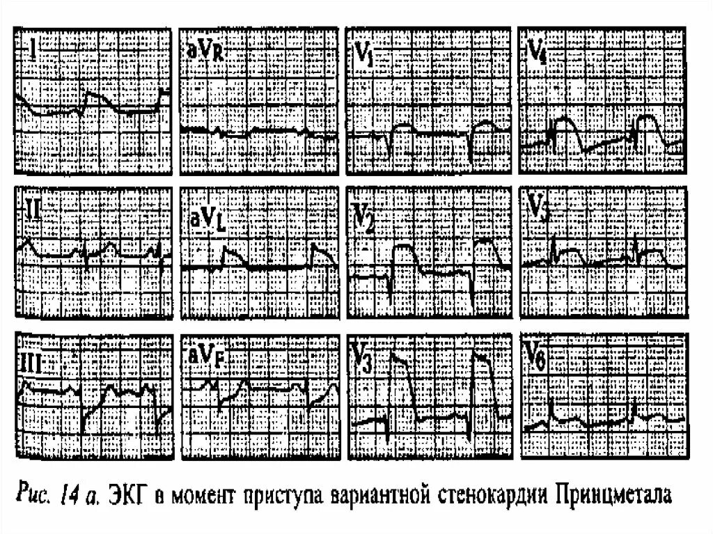 Стабильная стенокардия напряжения экг. Экг принцметала. Электрокардиография в покое образец здорового человека. Изменения экг характерные для стенокардии. Электрокардиография в покое в спорте.