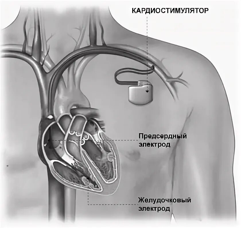 Кардиостимулятор что можно что нельзя. Операция кардиостимулятор сердца. Трехкамерный кардиостимулятор. Имплантируемый кардиостимулятор.