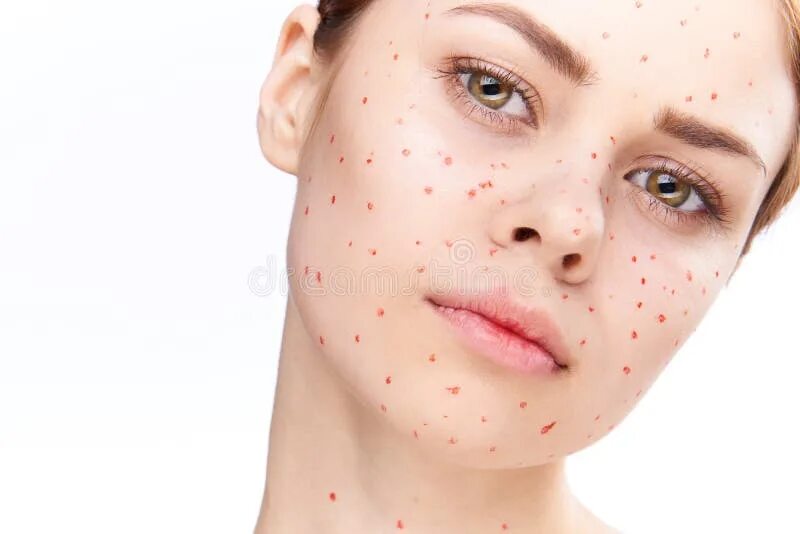 Как выглядят подростковые прыщи на лице Pin on Nuskin
