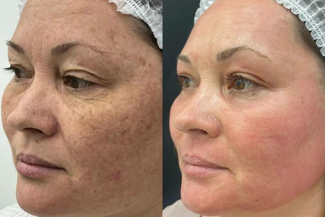 Bbl до и после фотоомоложение. Процедура bbl для лица отзывы. Результат сразу после процедуры bbl forever young. Фотоомоложение bbl forever young. Процедура bbl для лица отзывы.