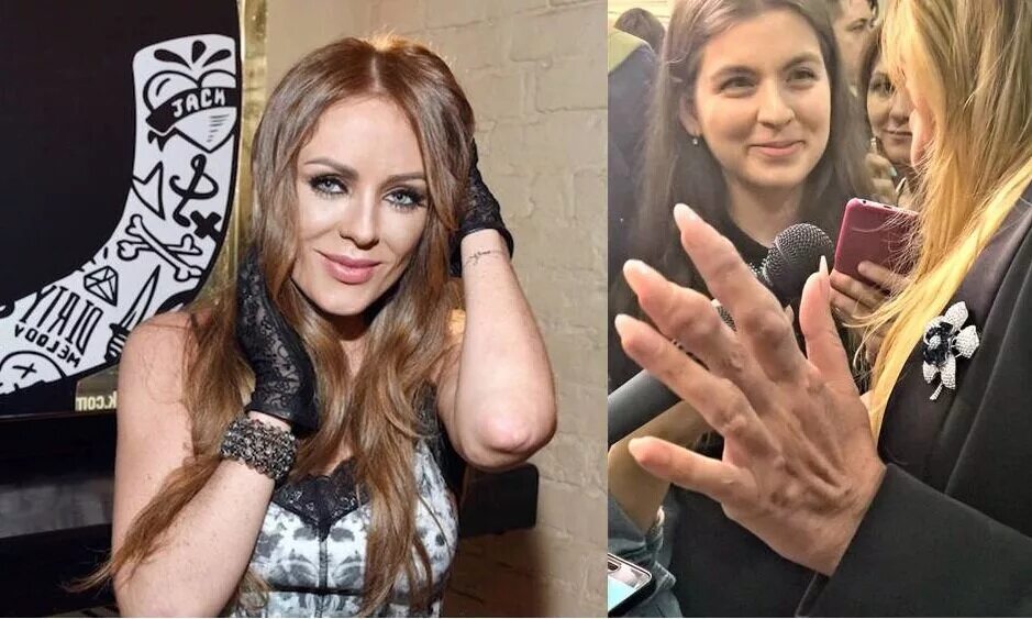 Подагра рук у юлии началовой. Болезнь началовой на руках. Болезнь началовой на руках. Началова руки подагра. Болезнь началовой на руках.