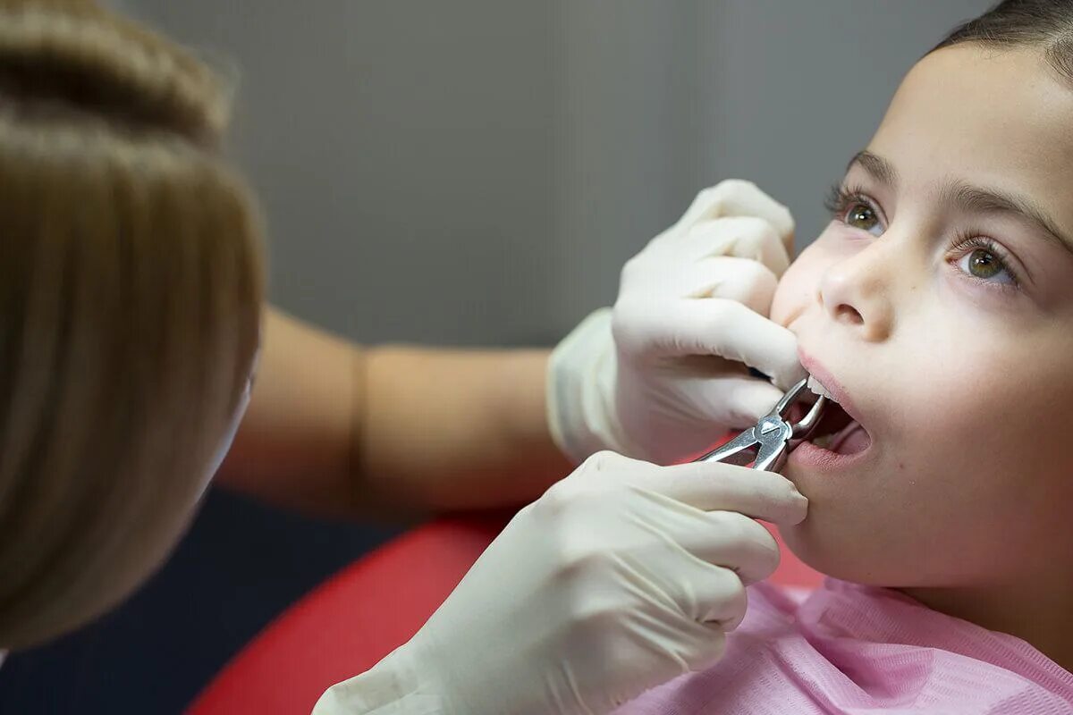 Удаление зуба. Вырывание молочных зубов у детей. Вырывание молочного зуба у ребёнка.