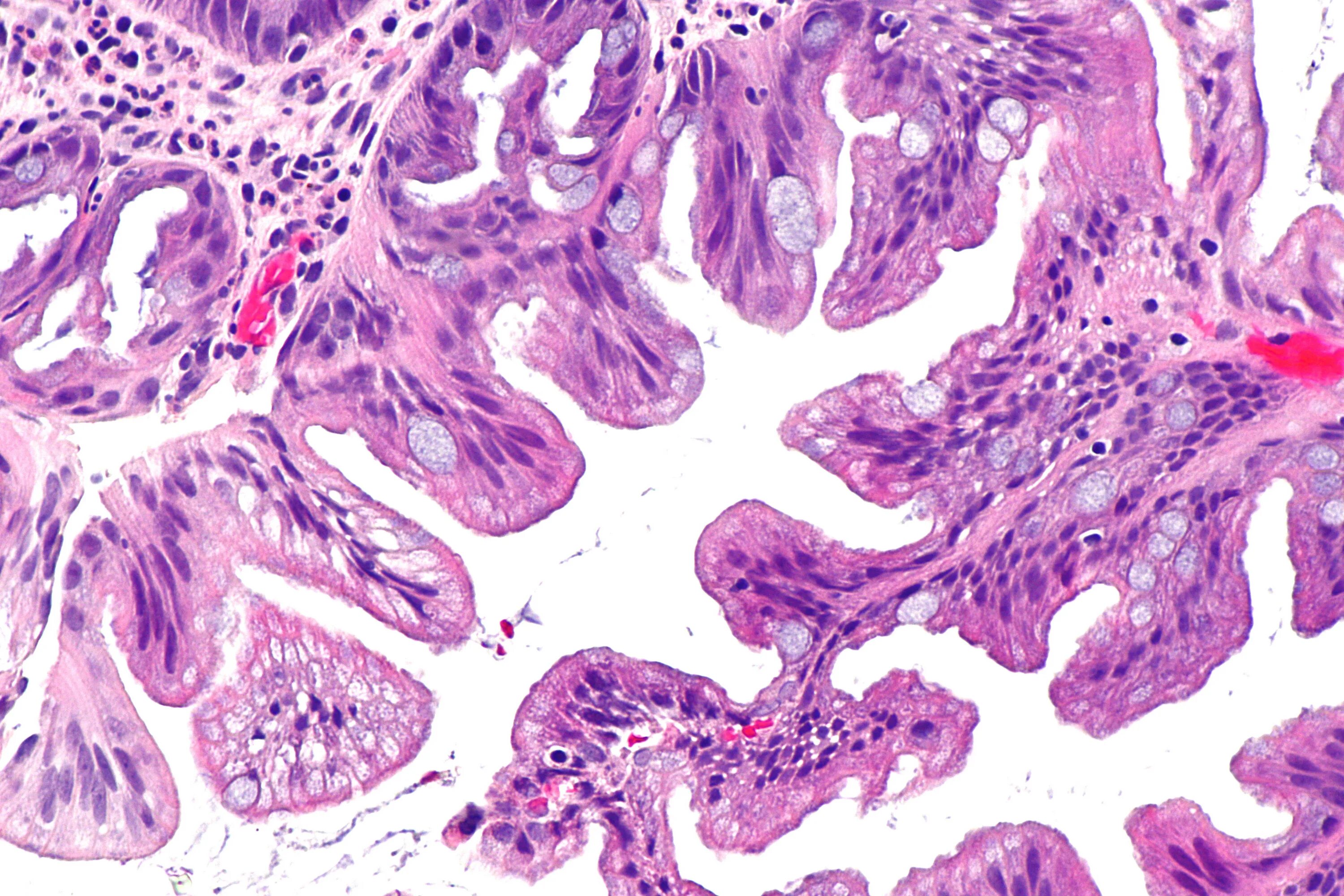 Ворсинчатая аденома гистология. Виллёзная гиперплазия. Ворсинчатый полип гистология. Тубуло ворсинчатая аденома желудка гистология. Тубулярная аденома толстой кишки что