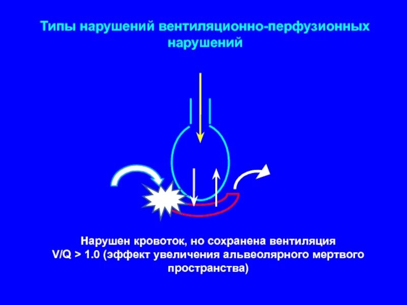 Типы вентиляционных нарушений. Нарушение вентиляционно-перфузионных. Типы нарушений вентиляционной функции легких. Типы нарушений вентиляционной способности легких это.