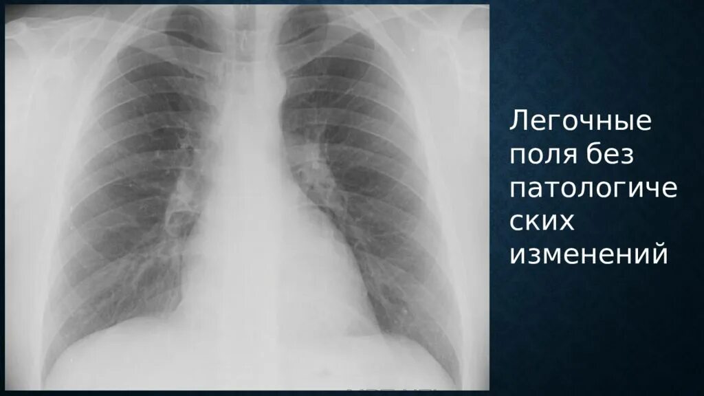 Без видимых изменений. Легкие без патологических изменений. Легочные поля. Легочные зоны. Легочные поля на рентгенограмме.