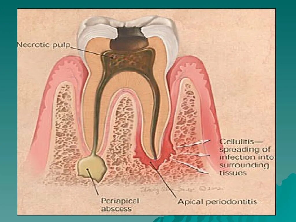 Пульпит воспаление десны. Периодонтит, периодонтальный абсцесс. Периапикальный абсцесс зуба. Пульпит Гнойный (пульпарный абсцесс.