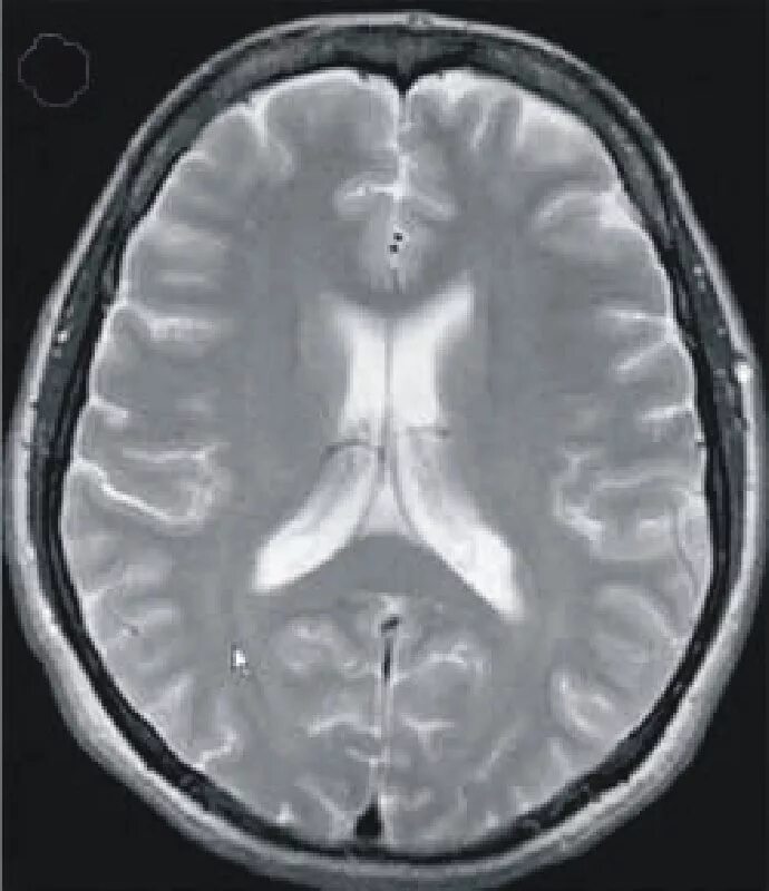 Гидроцефалия головного мозга мрт. Снимки мрт гидроцефалия головного мозга. Нормотензивная гидроцефалия. Гидроцефалия снимок мрт.