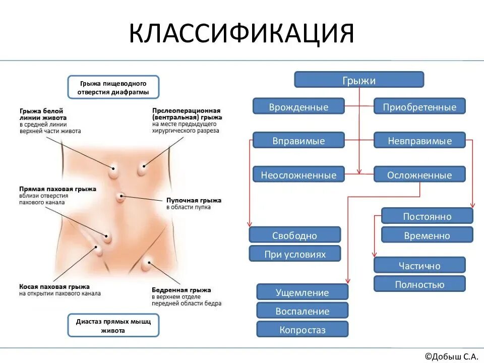 Заболевания брюшной стенки. Грыжи брюшной полости классификация. Грыжи живота классификация хирургия. Вентральная грыжа классификация. Наружные брюшные грыжи классификация.