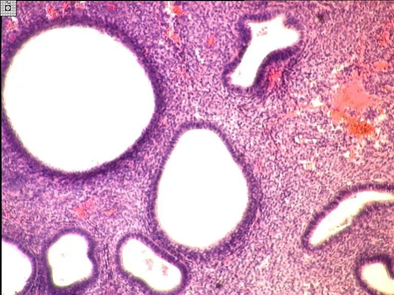 Железистая гиперплазия эндометрия патанатомия. Железистая гиперплазия слизистой оболочки матки макропрепарат. Железистая гиперплазия эндометрия макропрепарат. Железистая гиперплазия эндометрия микропрепарат патанатомия.