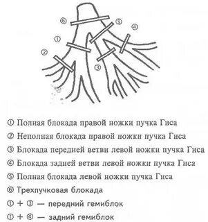 Блокада ножки гипса