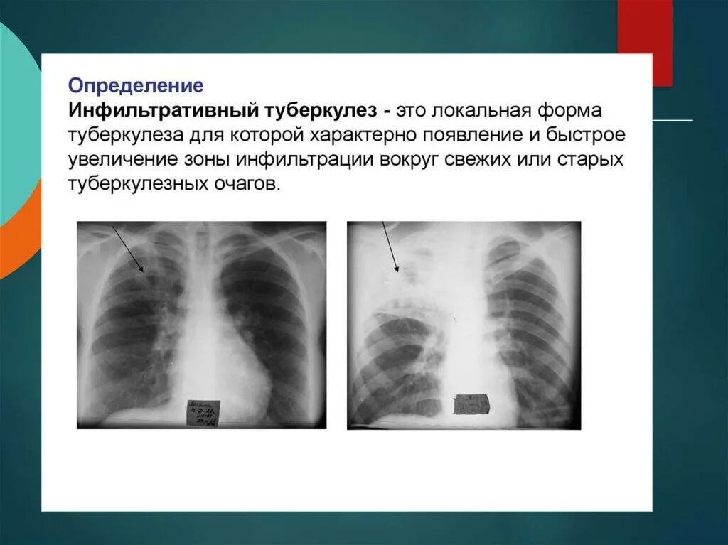 Изменения в верхней доле легкого. Очагово-инфильтративный туберкулез рентген. Инфильтративная форма туберкулеза рентген. Инфильтративный туберкулёз с1 с2 с6. Очаговый туберкулез рентген.