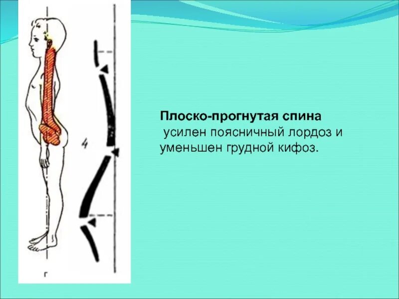 Усиленный лордоз. Лордоз. Кифоз. Поясничный лордоз. Поясничный лордоз усилен.