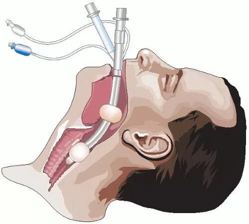Интубация трахеи наркоз. Анестезия: эндотрахеальный наркоз.. Интубация оксигенотерапия. Интубация трахеи через горло. Трубка во время операции